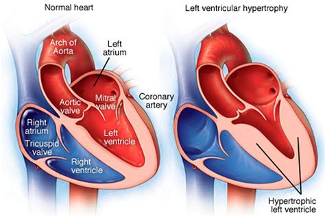 left ventricular heart